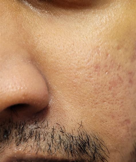 [skin concerns] Red spots appearing on face. I have sensitive, acne ...