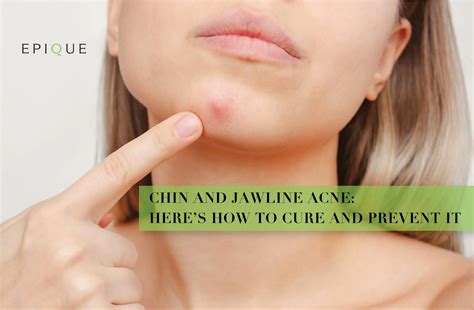 Acne on Chin and Jawline: What Causes It & How to Prevent It? – MyEpique.in