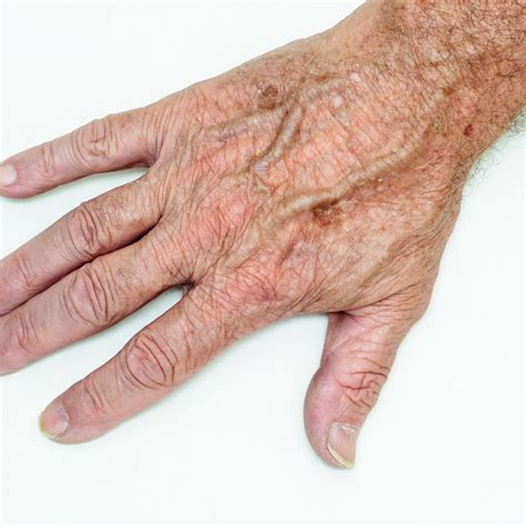 What Causes Dark Spots On Back Of Hands at Linda Fujiwara blog