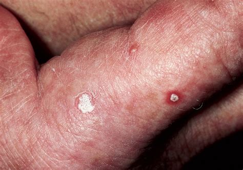 Fotos de câncer de pele | Qual é a aparência do câncer de pele?