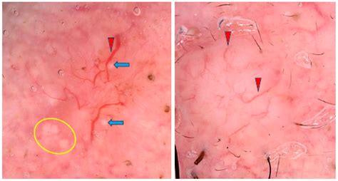 Dermoscopy of Basal Cell Carcinoma Part 2: Dermoscopic Findings by Lesion Subtype, Location, Age ...