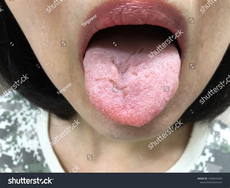 Worst Fissured Tongue