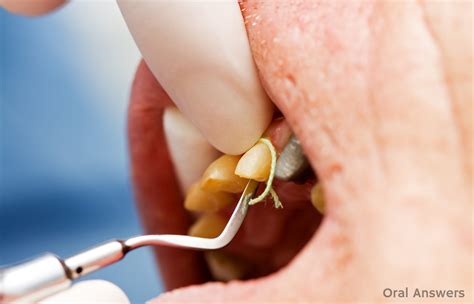 Dental Gingival Retraction Cord: What It Is and Why We Use It | Oral ...