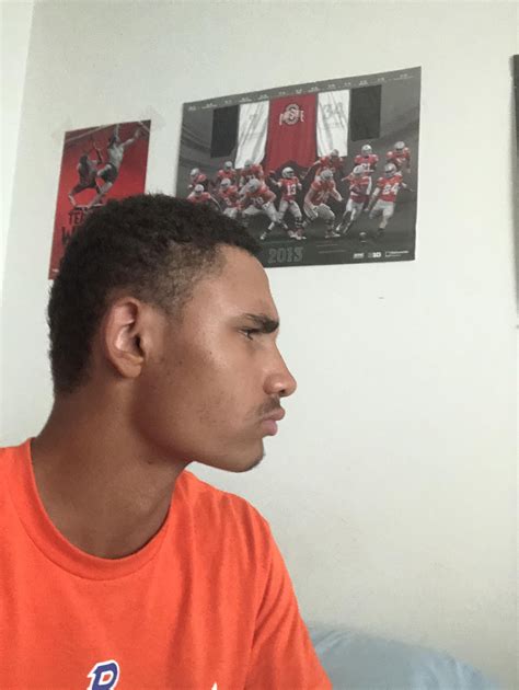 15 and recessed/ugly w/ upper eyelid exposure ——> 18 and still ugly but ...