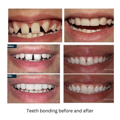 What Is Teeth Bonding