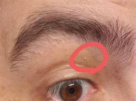 Bump(s) on/above eyelid : r/DermatologyQuestions