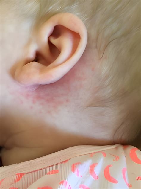 Lump Behind Ear Lobe Baby at Jessica Burnell blog
