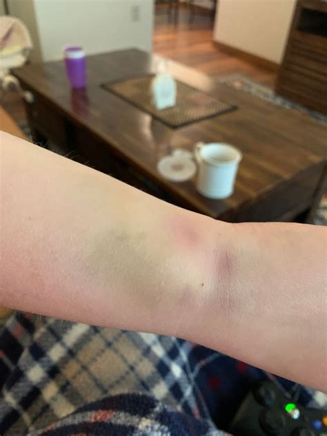 Iv Bruise