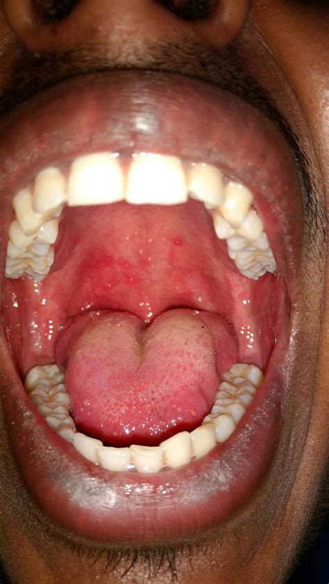 Mouth Sores From Rubber Bands at Michael Brehm blog