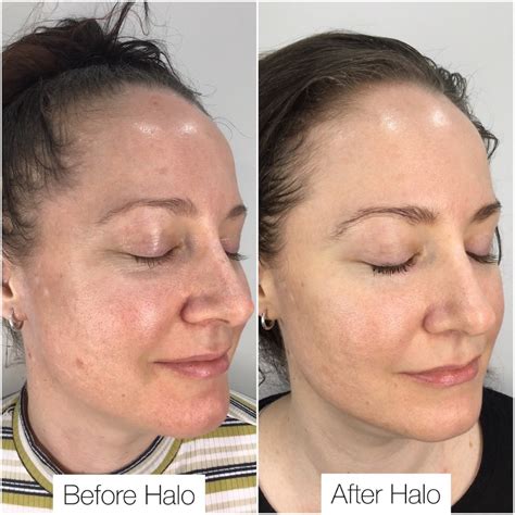 Halo Laser Face Before And After at Sara Gosman blog