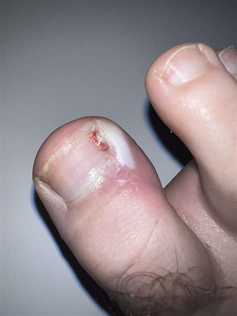Ingrown nail help please : r/Ingrown_Toenails