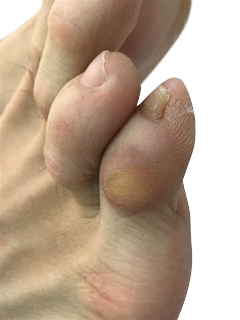 Soft Corn Between Toes Uk at Kelly Alexander blog