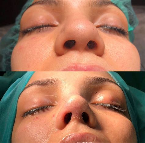 The perfect nose | Cirugia de nariz ancha, Cirujia de nariz, Rinoplastia