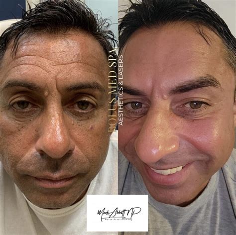 Halo Laser Resurfacing - Columbia, MD - Bolus Med Spa Annapolis, Baltimore
