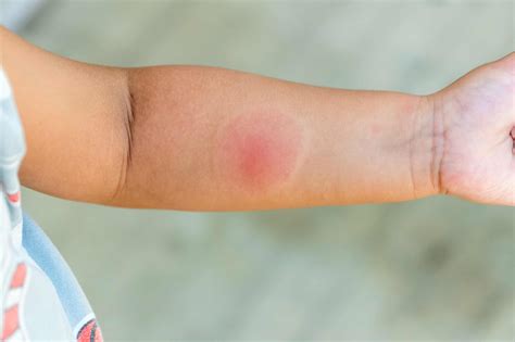 Best Treatment for Insect Bites: When to Seek Medical Attention - Aroga Pharmacy