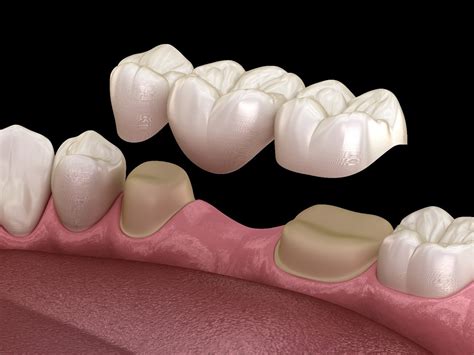 Dental Bridges - Dentist Christchurch - Pathway Dentists