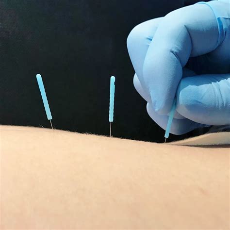 Mooresville, NC Dry Needling | Dry Needling in Mooresville