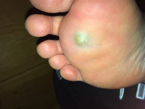 Blood Blister On Foot Under Skin, These Blisters Will Haunt Your Nightmares Runner S World, We ...