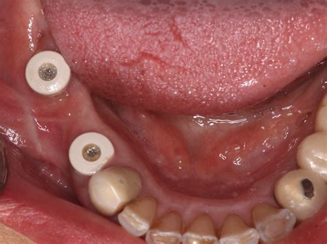 Six Single Tooth Implants - Dental Implant Solutions