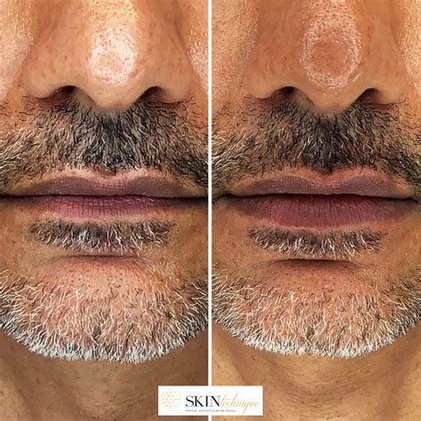 Male Lip Shapes Chart