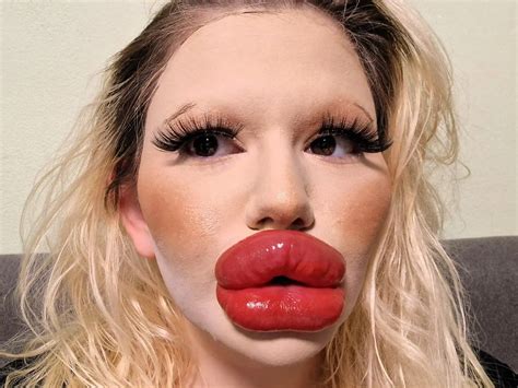 Woman with ‘world’s biggest lips’ gets filler on either side of nose to ...