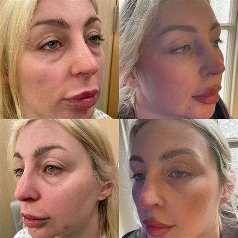 Bags Under Eyes Laser Surgery For Under Eye Bags: All You Need To Know
