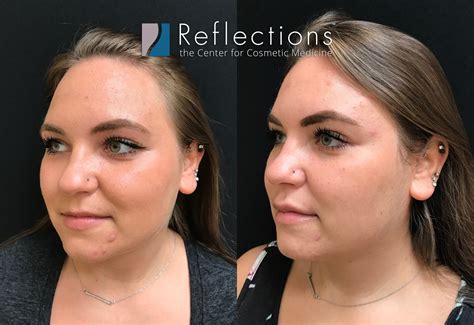 Lip Injections Before And After 1Ml at Alonzo Christensen blog