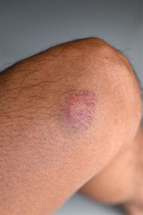 bruised on knee - wound bruised on leg caused by sports and bump or fall, leg injury 13760856 ...