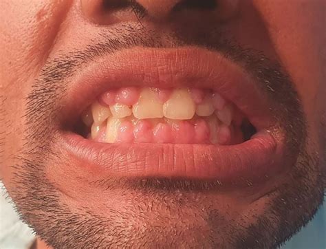 Gingival Hyperplasia With Calculus