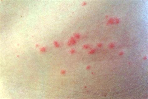 Sea Lice Bites Symptoms and Treatments