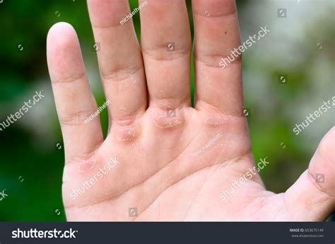 5,734 Calluses On Hand Royalty-Free Photos and Stock Images | Shutterstock