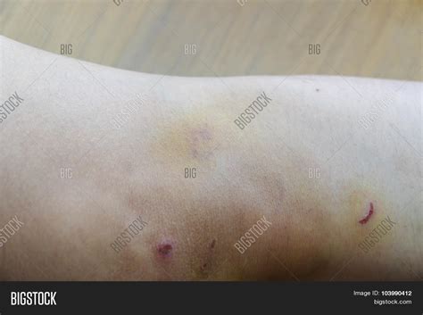 Knee Bruise Contusion Image & Photo (Free Trial) | Bigstock