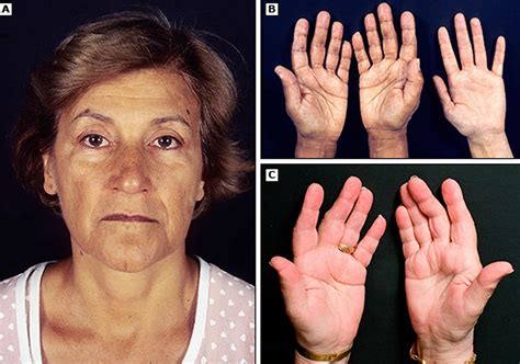 The way you prepared Skin pigmentation loss causes ~ skin nourse