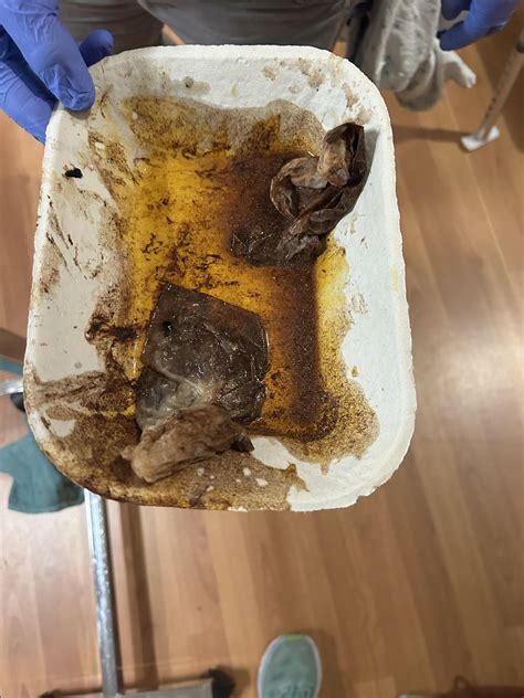 Coffee ground emesis : r/MedicalGore