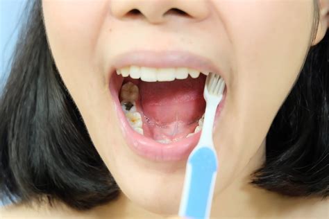 Why You Keep Getting Cavities and How to Prevent Them