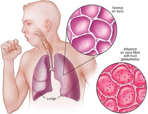 Aspiration, lung aspiration causes, signs, symptoms, diagnosis & treatment