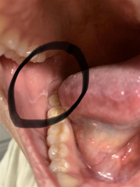 Linea Alba Cheek Biting