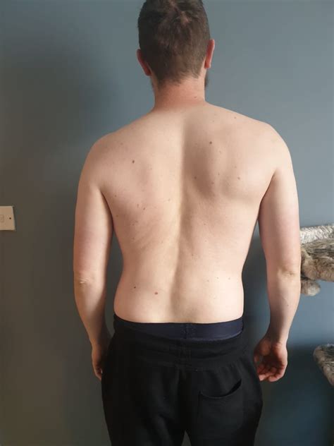 Back pain with moveable lump. : r/backpain