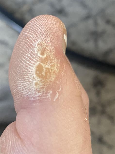 Are these things on my toes warts or calluses? I had treatments done at the derm for the warts ...