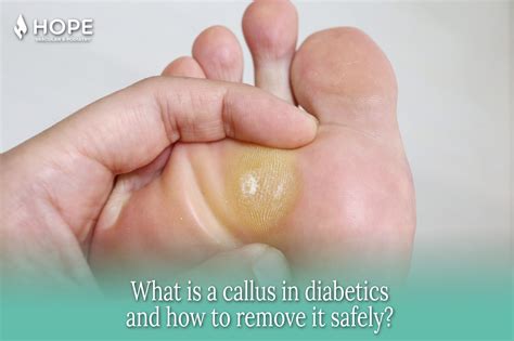 What is a Callus in Diabetics and How to Remove It Safely? - Houston ...