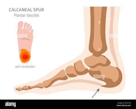 Calcaneal spur. Plantar fasciitis set. Medical desease infographics ...