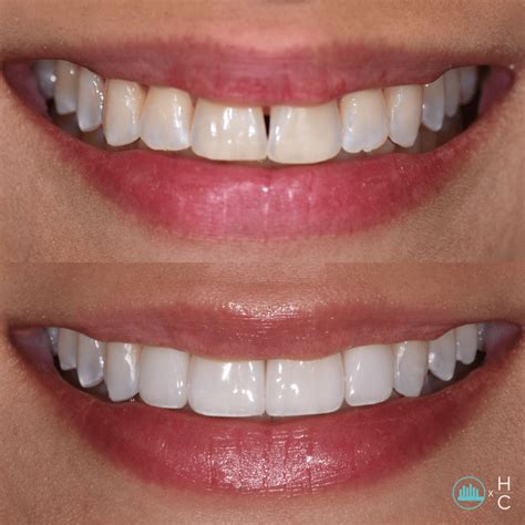Veneers Teeth Cons at Sandra Madrigal blog