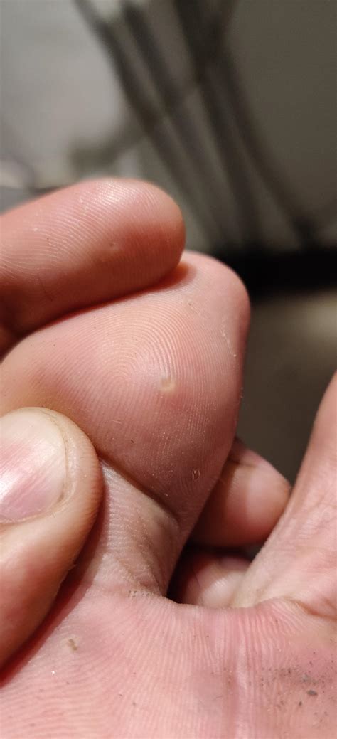 Small Bump On Sole Of Foot Best Sale | emergencydentistry.com