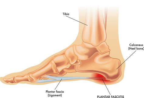 Fascitis plantar: síntomas y tratamiento - Clínica DKF