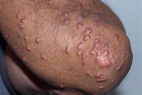 Cholesterol Deposits On Face