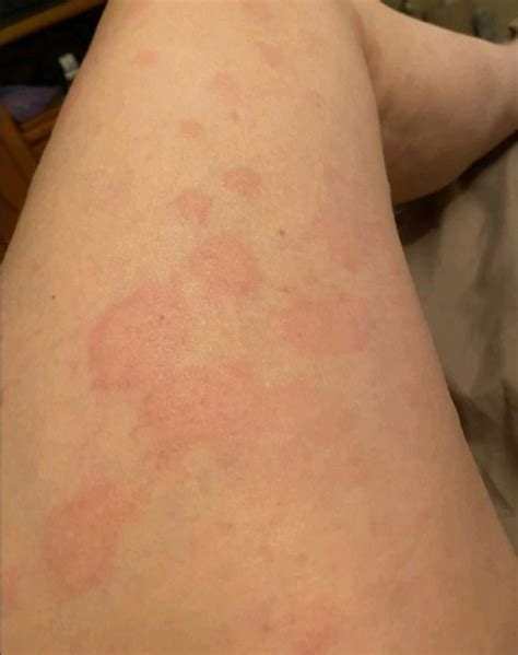 Pictures to help you identify hives vs other skin rashes – Artofit