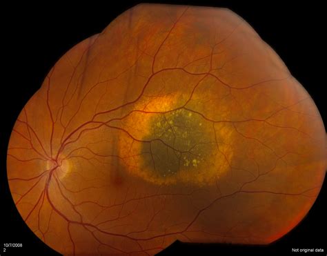Pigmented Retinal Lesions