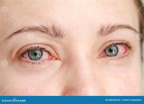 Close Up of Red Irritated Human Eyes, Allergy Symptom, Conjunctivitis Stock Photo - Image of ...