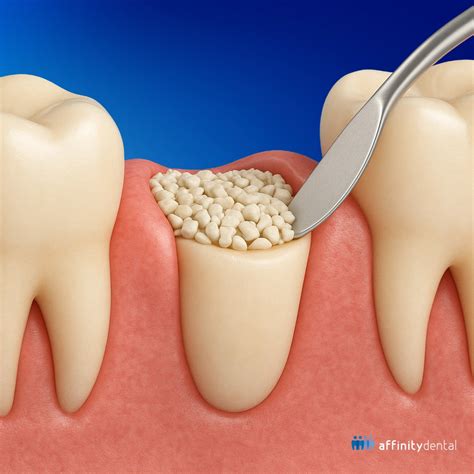 Why Do You Need a Bone Graft for Dental Implants?