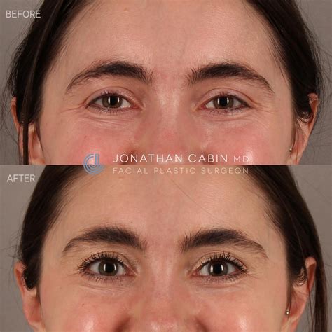 Crow’s Feet Botox - CabinMD Facial Plastics & Aesthetics